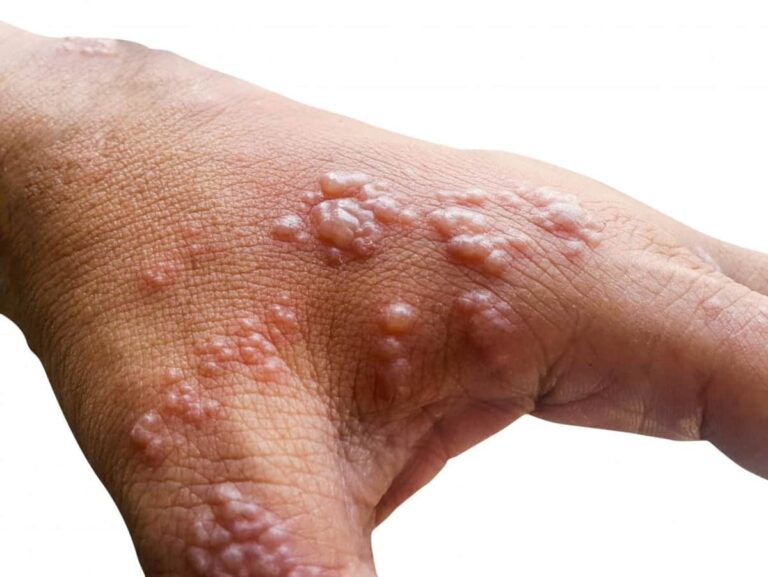 করোনা ভাইরাসের পর হানা দিচ্ছে মাঙ্কিপক্স (monkeypox)